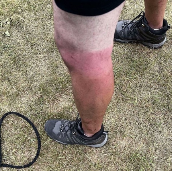 Эти фотографии показали, почему использовать солнцезащитный крем — хорошая идея!