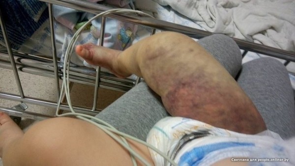 Нога опухла и почернела. Если гадюка укусила ребенка: вспоминаем последствия и учимся реагировать