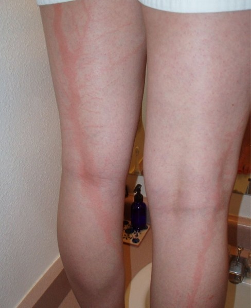 После разряда — что происходит с человеком, в которого ударила молния После разряда — что происходит с человеком, в которого ударила молния