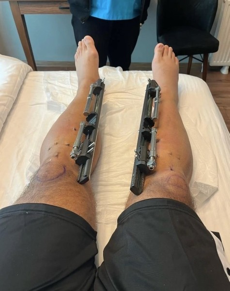 Мужчина потратил 100 тысяч евро, чтобы увеличить свой рост. «Вырос» до двух метров